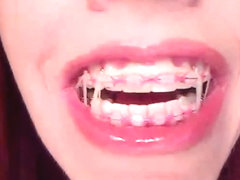 LBFM with Marangos and Braces Done 4 Times